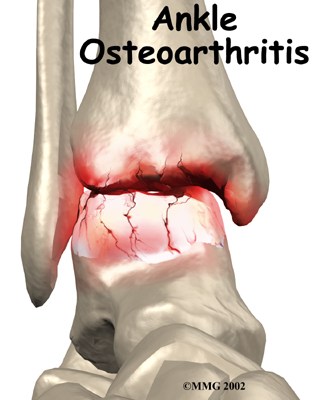 Osteoarthritis of the Ankle