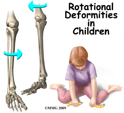 Guide for Rotational Deformities in Children