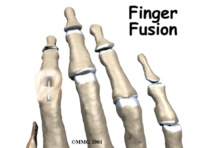 Finger Fusion Surgery - Momentum Health's Guide