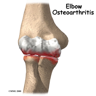 Osteoarthritis of the Elbow Patient Guide