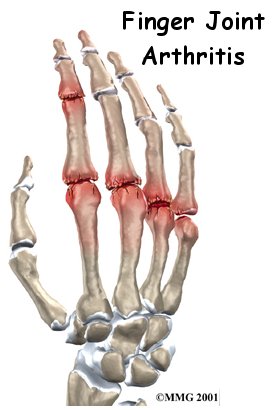 Arthritis of the Finger Joints